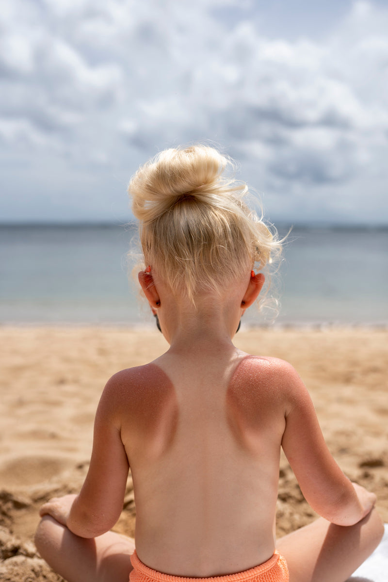 Sunburn